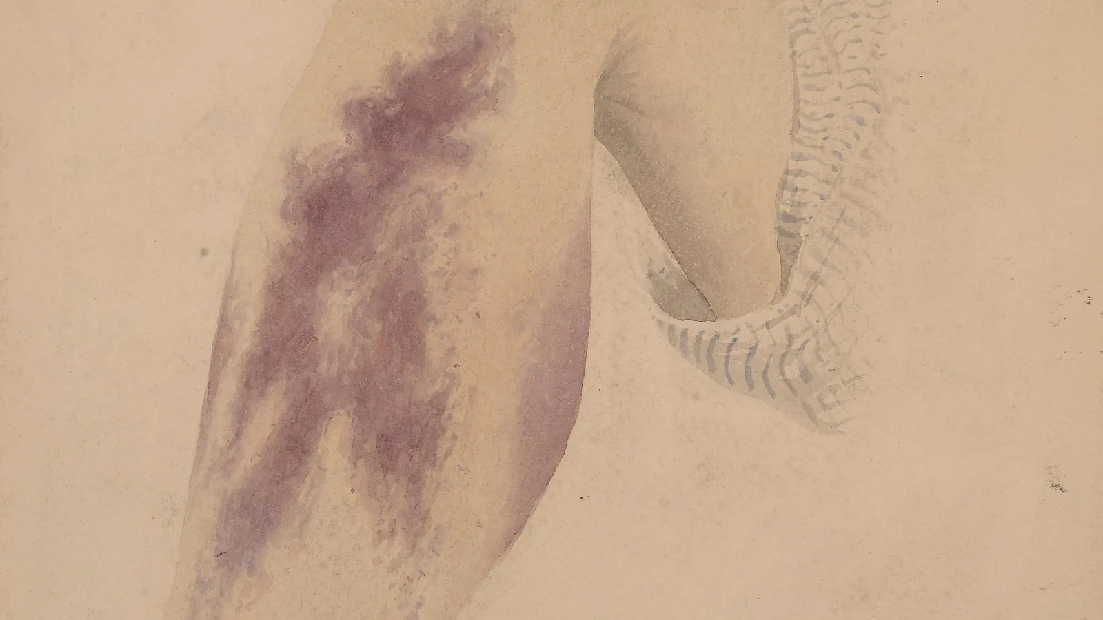 Historische medizinische Aquarellzeichnung eines Beins mit sichtbaren Hautveränderungen bei Skorbut.